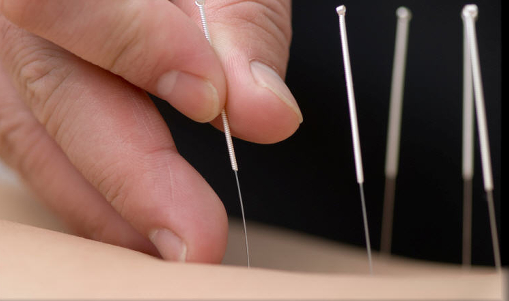 Licensed Acupuncturist, Acupuncture needles